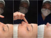 Imagens-de-uma-rinoplastia-torna-se-viral-e-gera-onda-de-criticas-ao-resultado-alcancado