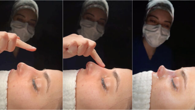 Imagens-de-uma-rinoplastia-torna-se-viral-e-gera-onda-de-criticas-ao-resultado-alcancado